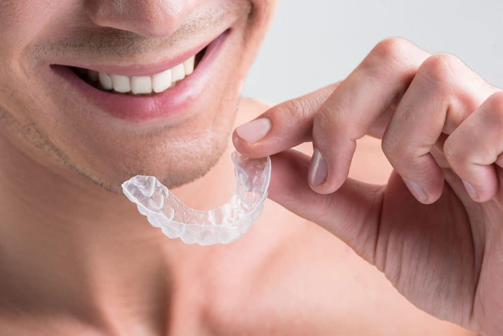 Clear Aligners 1024x684