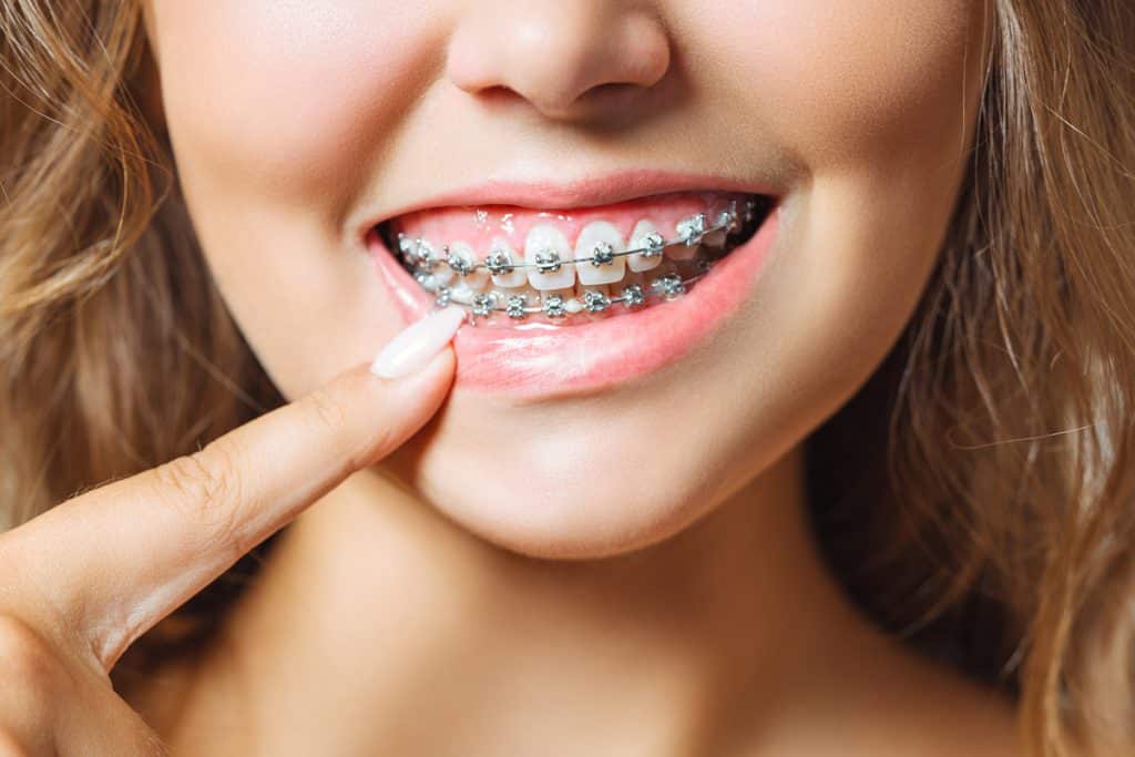 Can You Get Braces Just On Your Bottom Teeth Blog 1024x683