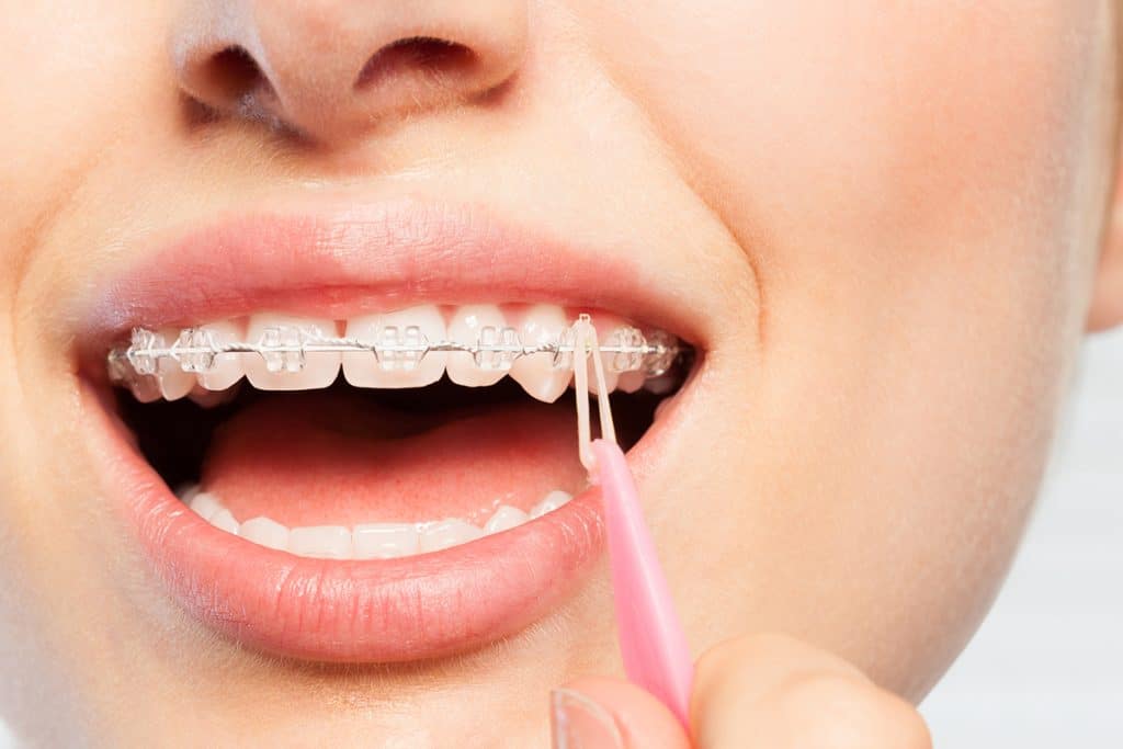 How To Floss While You Have Braces Blog 1024x683